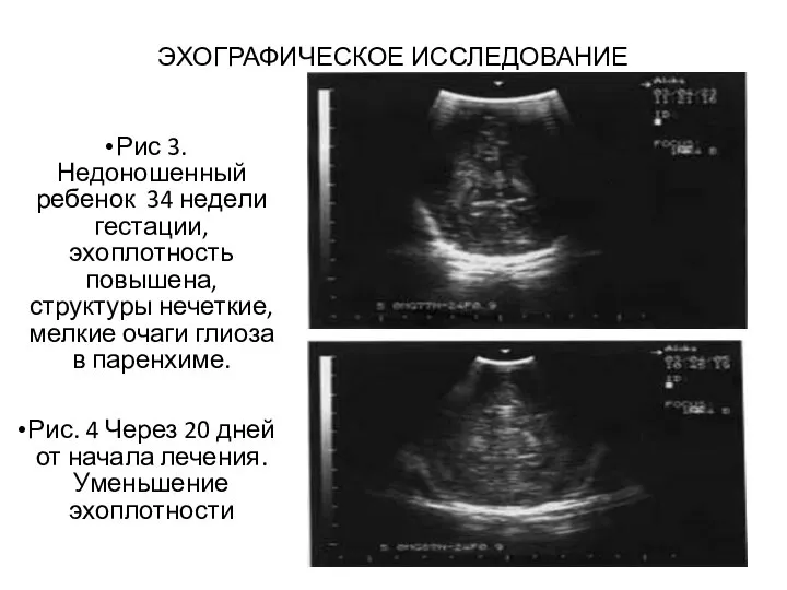 ЭХОГРАФИЧЕСКОЕ ИССЛЕДОВАНИЕ Рис 3. Недоношенный ребенок 34 недели гестации, эхоплотность повышена, структуры