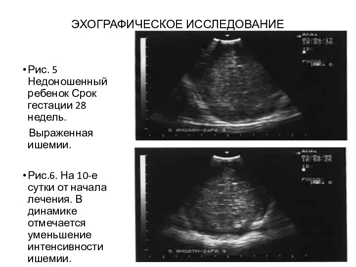 ЭХОГРАФИЧЕСКОЕ ИССЛЕДОВАНИЕ Рис. 5 Недоношенный ребенок Срок гестации 28 недель. Выраженная ишемии.