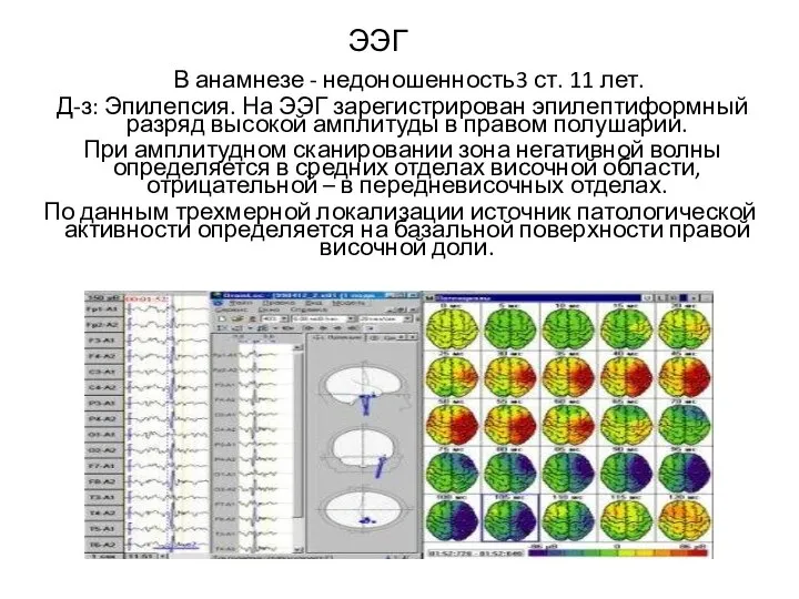 ЭЭГ В анамнезе - недоношенность3 ст. 11 лет. Д-з: Эпилепсия. На ЭЭГ