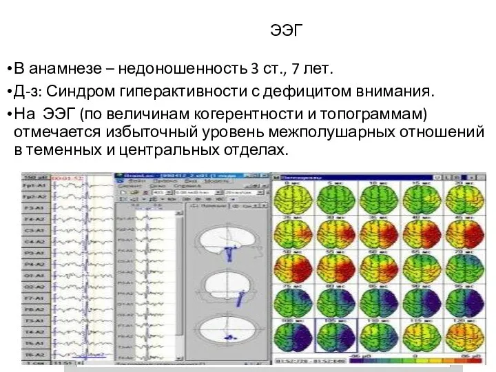 ЭЭГ В анамнезе – недоношенность 3 ст., 7 лет. Д-з: Синдром гиперактивности