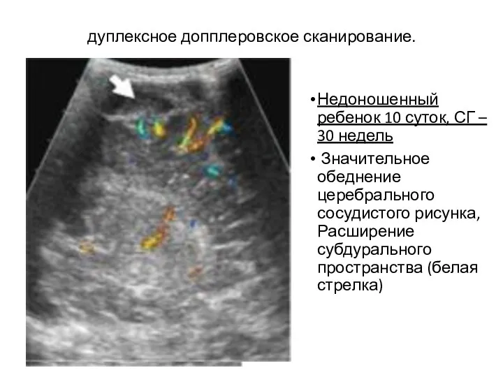 дуплексное допплеровское сканирование. Недоношенный ребенок 10 суток, СГ – 30 недель Значительное