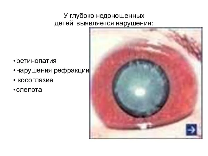 У глубоко недоношенных детей выявляется нарушения: ретинопатия нарушения рефракции косоглазие слепота