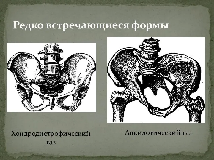 Редко встречающиеся формы Хондродистрофический таз Анкилотический таз