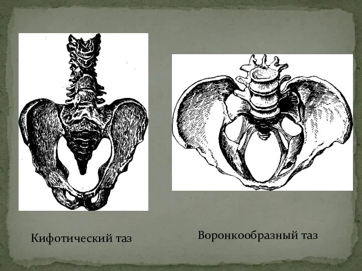 Кифотический таз Воронкообразный таз