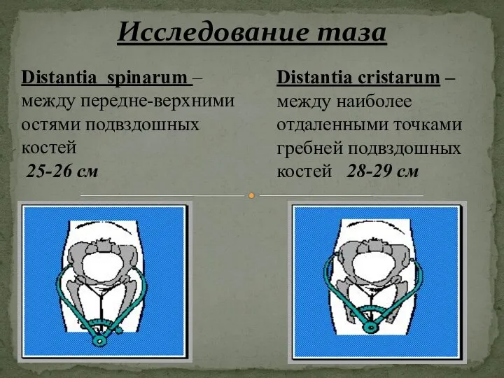 Исследование таза Distantia spinarum – между передне-верхними остями подвздошных костей 25-26 см