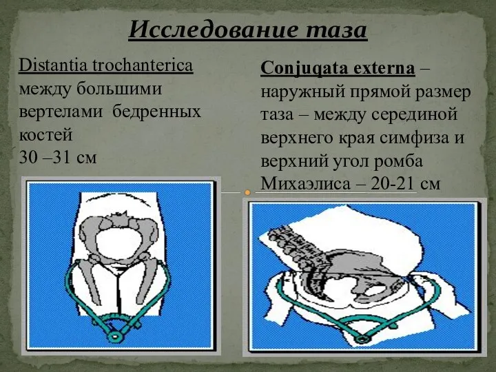 Исследование таза Distantia trochanterica между большими вертелами бедренных костей 30 –31 см