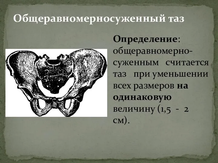 Общеравномерносуженный таз Определение: общеравномерно-суженным считается таз при уменьшении всех размеров на одинаковую