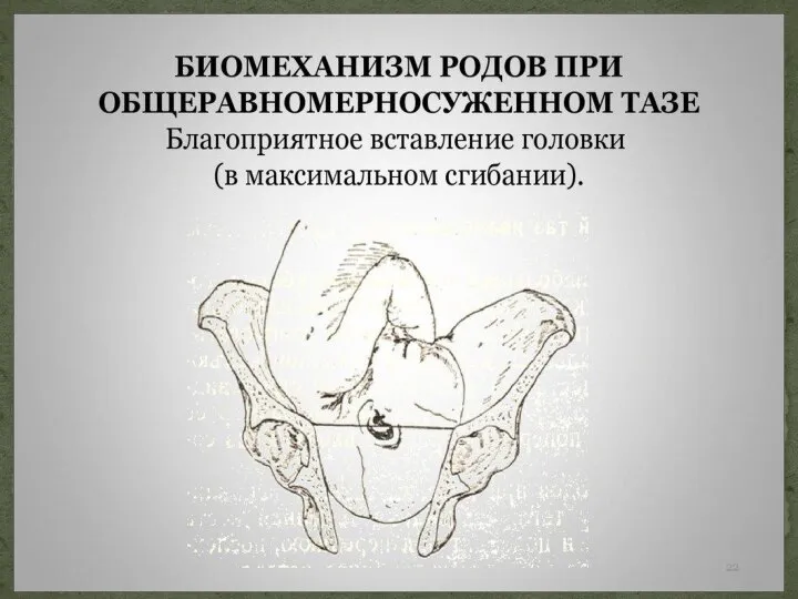 Беременные обычно небольшого роста, правильного телосложения, таз имеет правильную форму. Плоскость входа