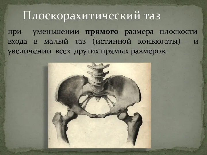 Плоскорахитический таз при уменьшении прямого размера плоскости входа в малый таз (истинной