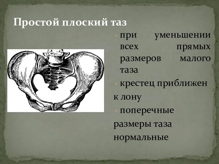 Простой плоский таз при уменьшении всех прямых размеров малого таза крестец приближен