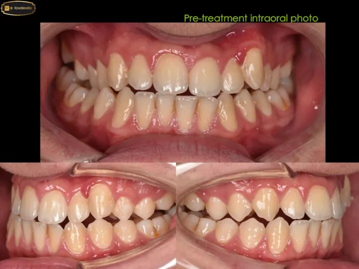 Pre-treatment intraoral photo