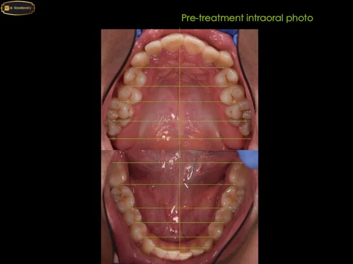 Pre-treatment intraoral photo