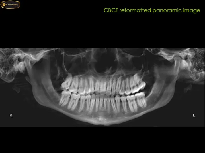 CBCT reformatted panoramic image