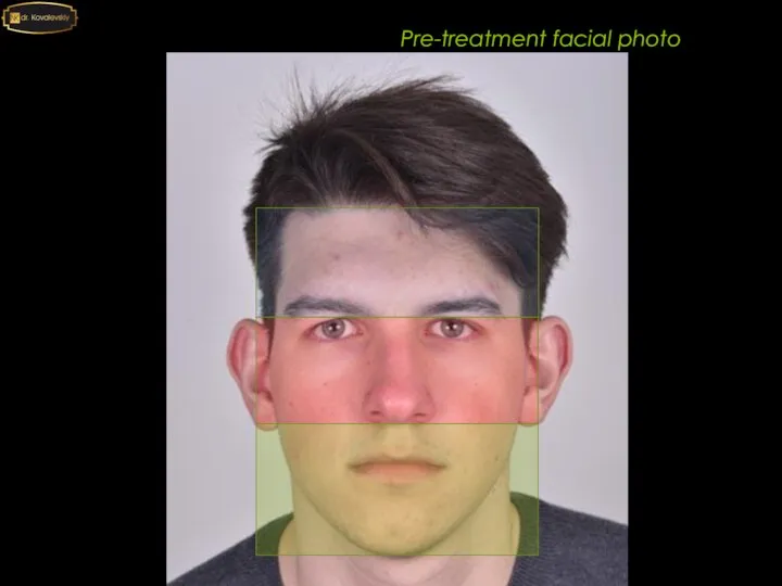 Pre-treatment facial photo