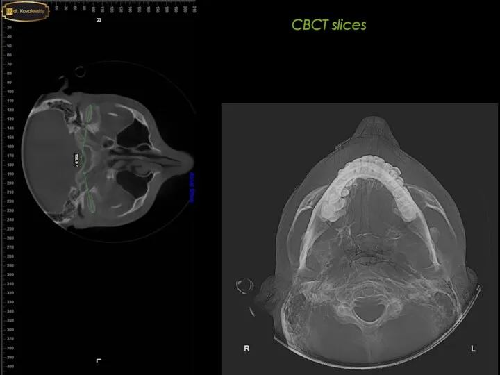 4-4 6-6 CBCT slices