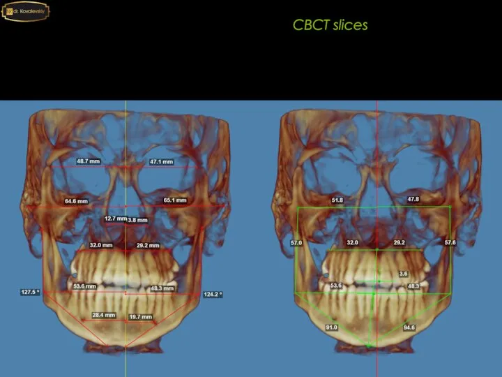 4-4 6-6 CBCT slices