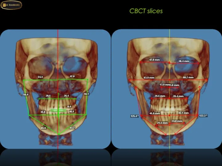 4-4 6-6 CBCT slices