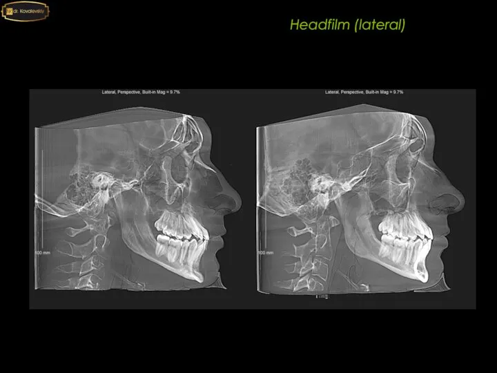 Headfilm (lateral)