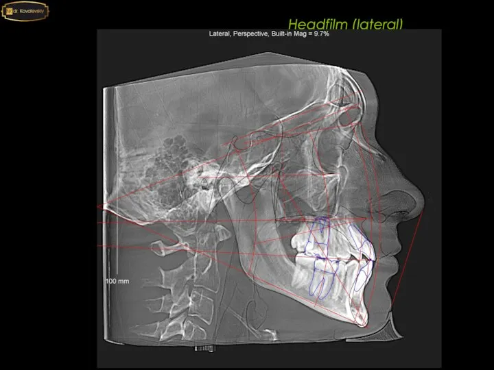 Headfilm (lateral)