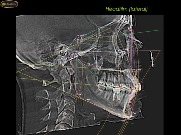 Headfilm (lateral)