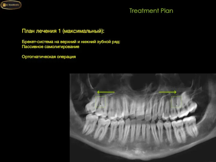 Treatment Plan План лечения 1 (максимальный): Брекет-система на верхний и нижний зубной