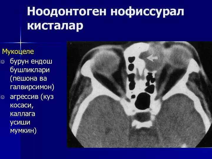 Ноодонтоген нофиссурал кисталар Мукоцеле бурун ендош бушликлари (пешона ва галвирсимон) агрессив (куз косаси, каллага усиши мумкин)