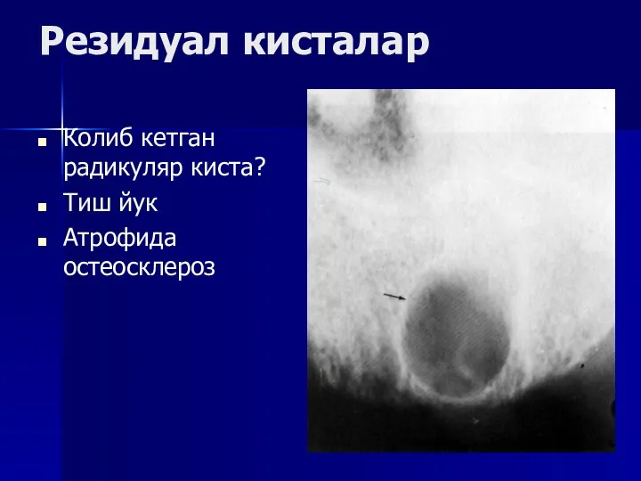 Резидуал кисталар Колиб кетган радикуляр киста? Тиш йук Атрофида остеосклероз