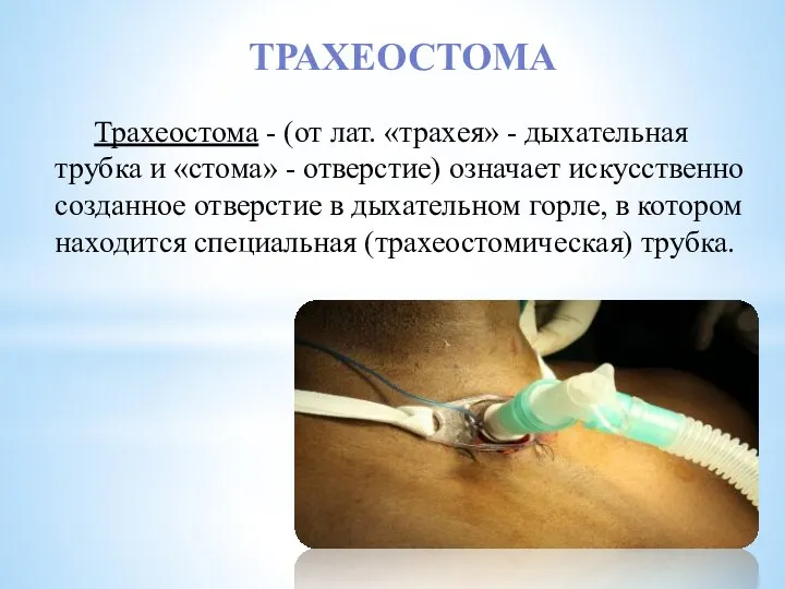 ТРАХЕОСТОМА Трахеостома - (от лат. «трахея» - дыхательная трубка и «стома» -
