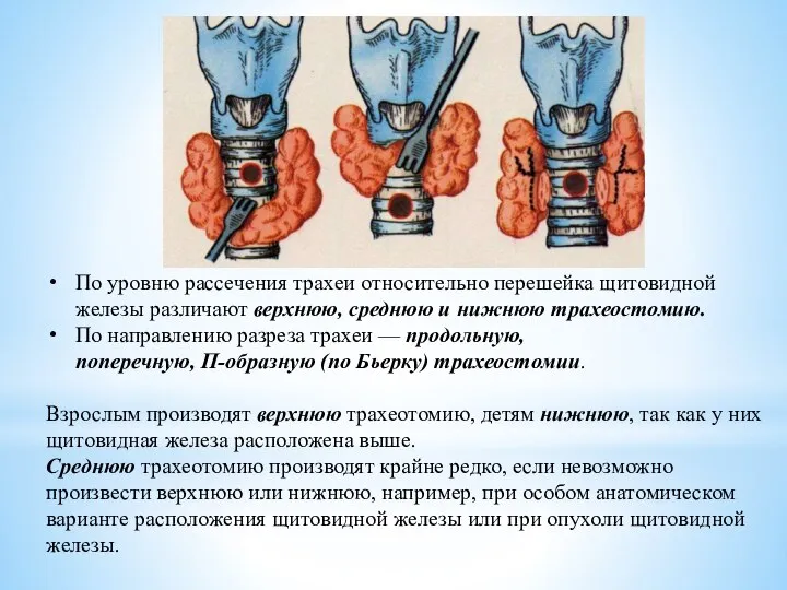 По уровню рассечения трахеи относительно перешейка щитовидной железы различают верхнюю, среднюю и