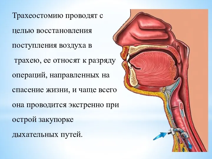 Трахеостомию проводят с целью восстановления поступления воздуха в трахею, ее относят к