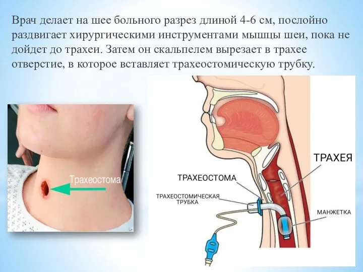 Врач делает на шее больного разрез длиной 4-6 см, послойно раздвигает хирургическими