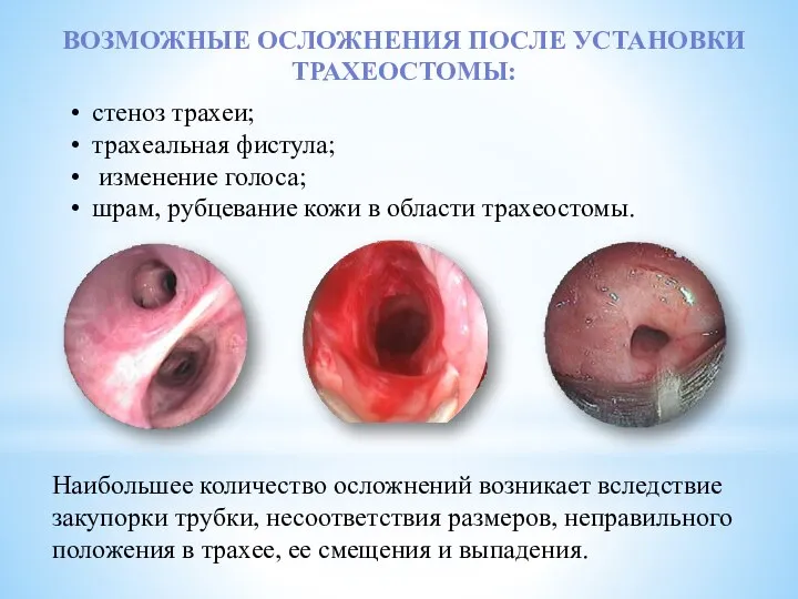 стеноз трахеи; трахеальная фистула; изменение голоса; шрам, рубцевание кожи в области трахеостомы.