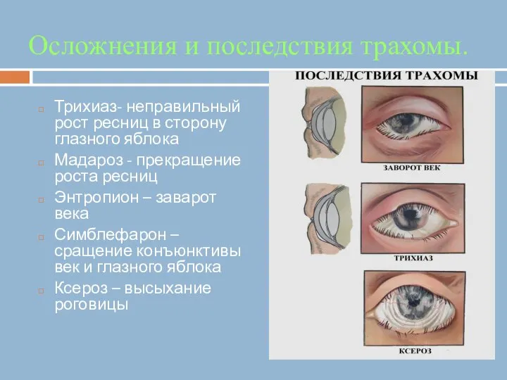 Осложнения и последствия трахомы. Трихиаз- неправильный рост ресниц в сторону глазного яблока