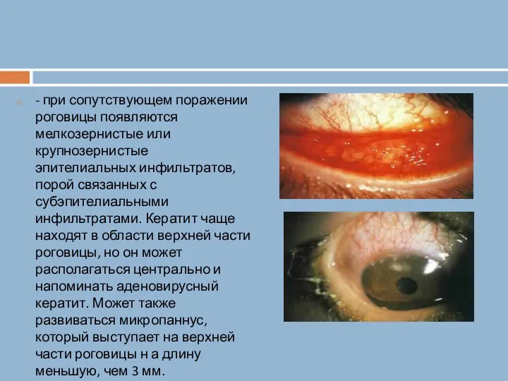- при сопутствующем поражении роговицы появляются мелкозернистые или крупнозернистые эпителиальных инфильтратов, порой