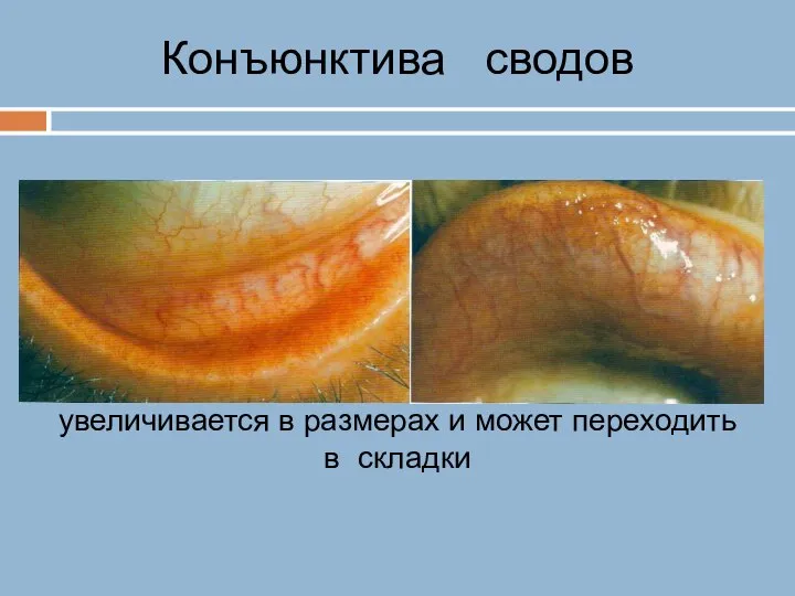 Конъюнктива сводов Конъюнктива сводов свободна, легко увеличивается в размерах и может переходить в складки