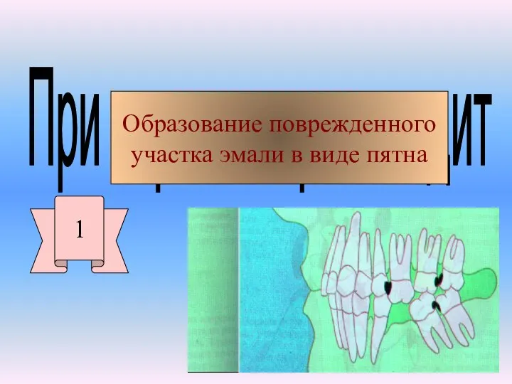 При кариесе происходит 1 Образование поврежденного участка эмали в виде пятна