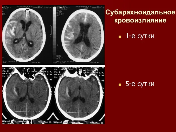 Субарахноидальное кровоизлияние 1-е сутки 5-е сутки