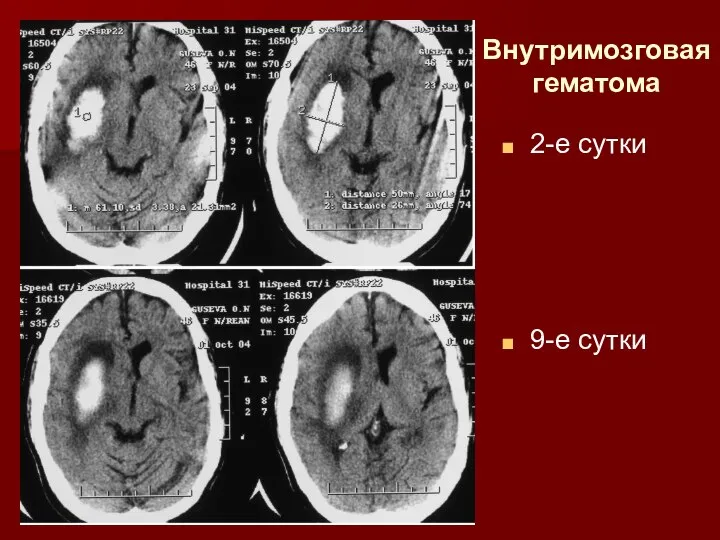 Внутримозговая гематома 2-е сутки 9-е сутки