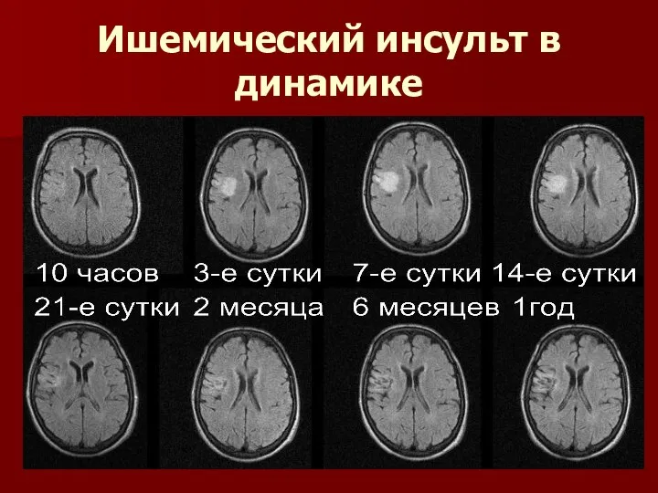 Ишемический инсульт в динамике