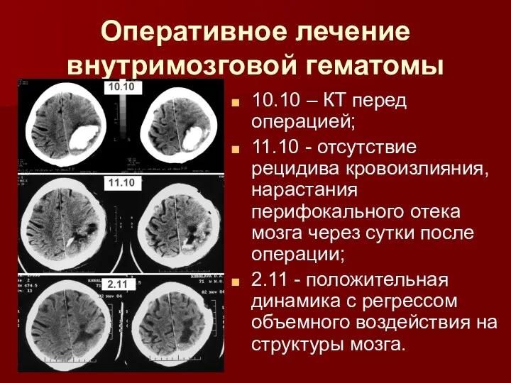 Оперативное лечение внутримозговой гематомы 10.10 – КТ перед операцией; 11.10 - отсутствие