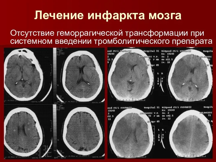 Лечение инфаркта мозга Отсутствие геморрагической трансформации при системном введении тромболитического препарата