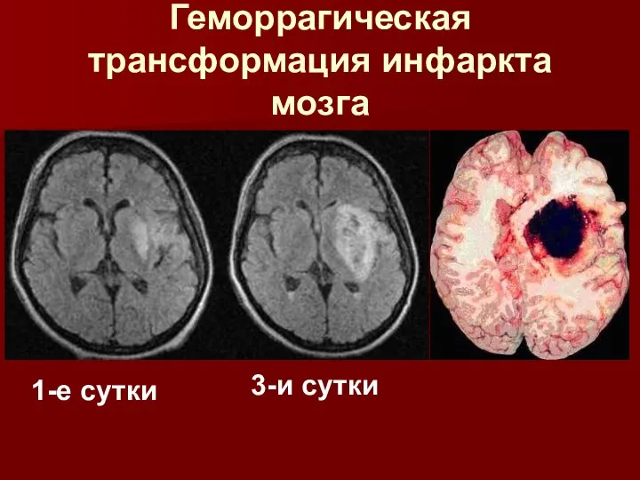 Геморрагическая трансформация инфаркта мозга 1-е сутки 3-и сутки