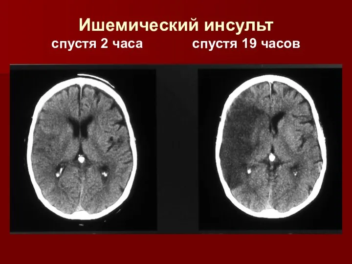 Ишемический инсульт спустя 2 часа спустя 19 часов