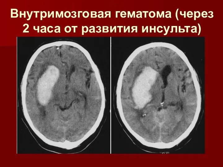 Внутримозговая гематома (через 2 часа от развития инсульта)