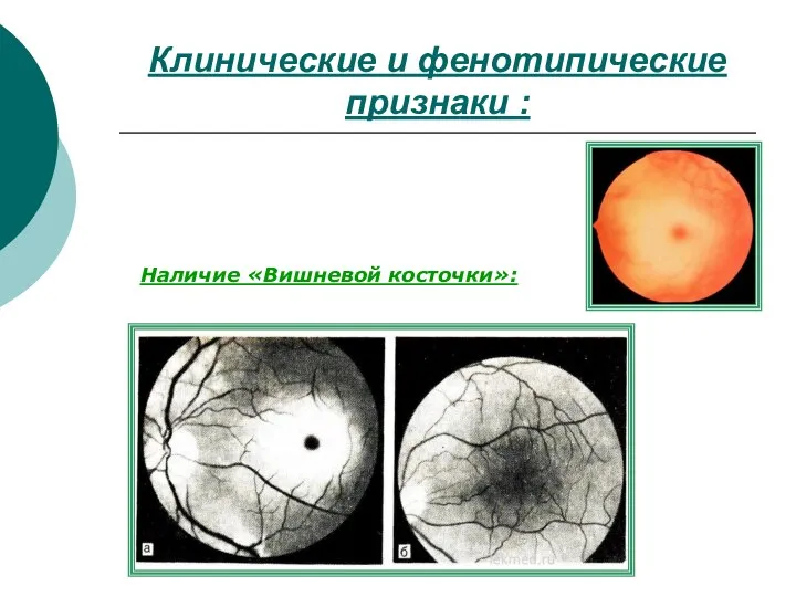 Клинические и фенотипические признаки : Наличие «Вишневой косточки»: