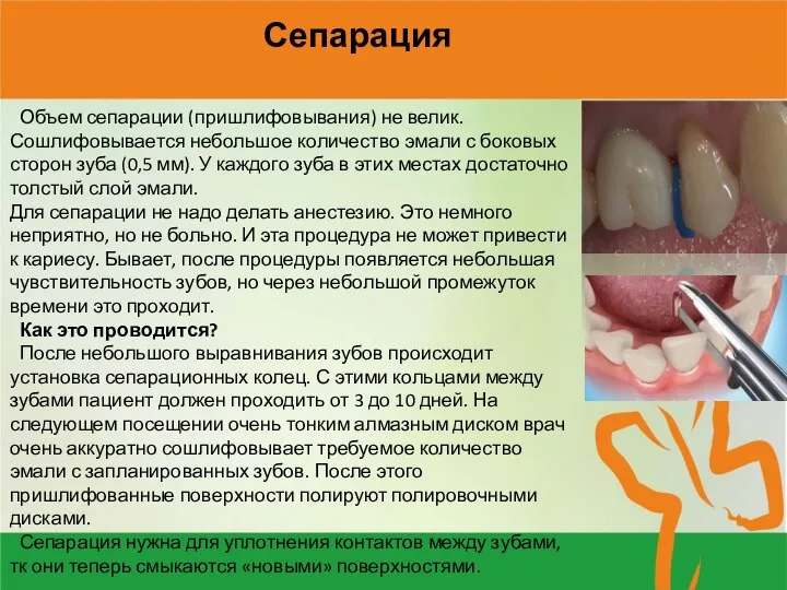 Сепарация Объем сепарации (пришлифовывания) не велик. Сошлифовывается небольшое количество эмали с боковых