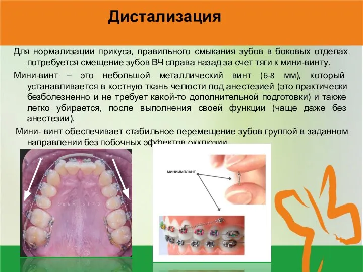 Дистализация Для нормализации прикуса, правильного смыкания зубов в боковых отделах потребуется смещение