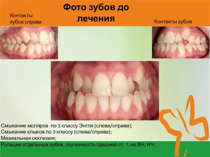Фото зубов до лечения Смыкание моляров по 3 классу Энгля (слева/справа); Смыкание