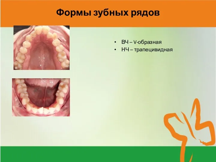 Формы зубных рядов ВЧ – V-образная НЧ – трапецивидная