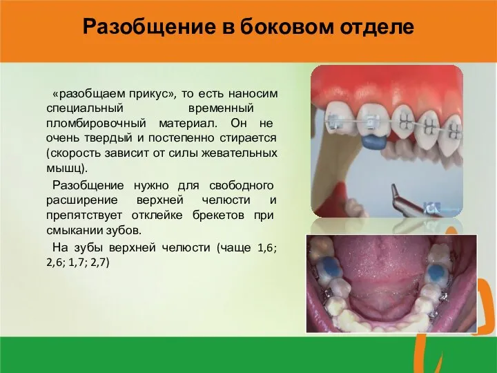 Разобщение в боковом отделе «разобщаем прикус», то есть наносим специальный временный пломбировочный